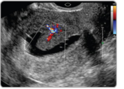 Sonohysterography Near me
