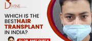 Top Hair Transplant In Delhi , Gurgaon (India)