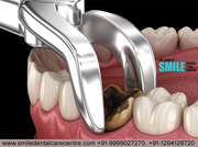 Painless Root Canal Treatment Clinic