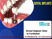 Dental Implants Treatment At Best Dental Implant Clinics in Faridabad
