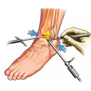 Robotic Total Knee Replacement